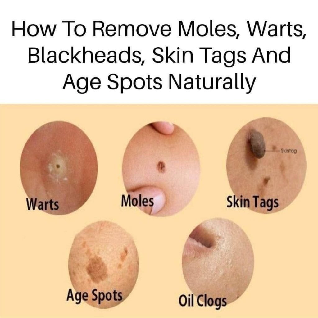 Natural Remedies to Address Skin Tags, Warts, and Blackheads