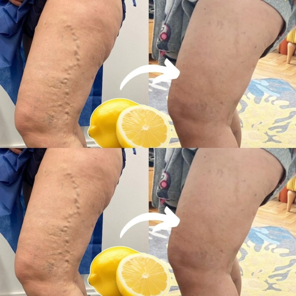 Lemon for Varicose Veins: A Simple Natural Remedy