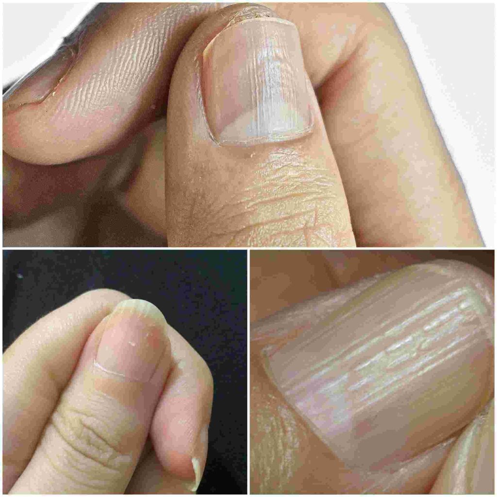 Understanding the Real Causes of Vertical Ridges on Your Nails