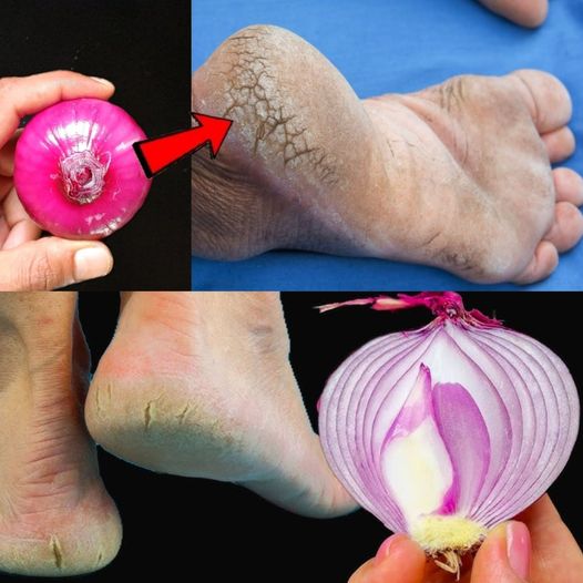 Remove Cracked Heels and Get Beautiful Feet Permanently – Magical Cracked Heels Home Remedy with Red Onion