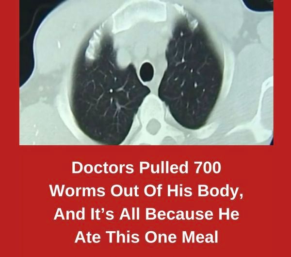 Doctors Pulled 700 Worms Out Of His Body, And It’s All Because He Ate This One Meal